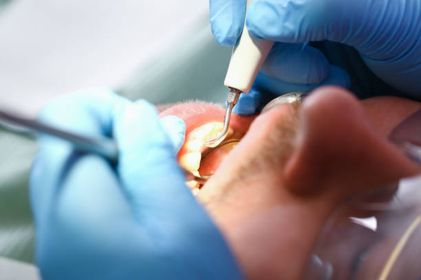 Best Emergency Tooth Extraction in Rib Mountain, WI
