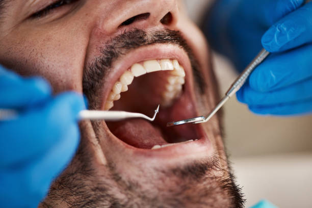 Best Emergency Tooth Extraction in Rib Mountain, WI